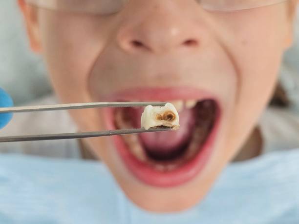 Best Emergency Root Canal Treatment in Marlette, MI
