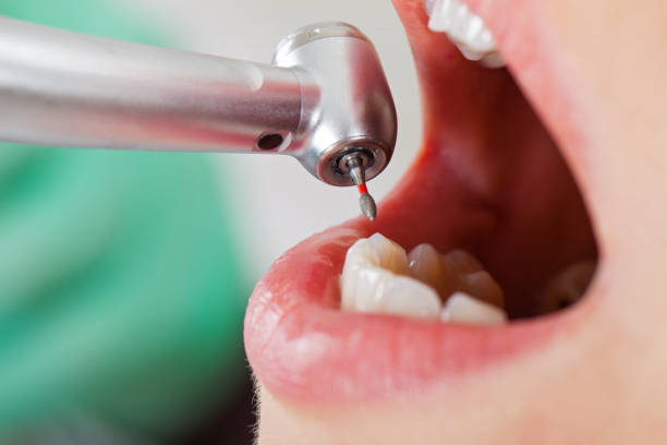 Best Emergency Tooth Extraction in Marlette, MI